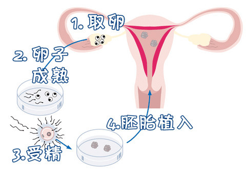 有偿捐卵供卵招聘